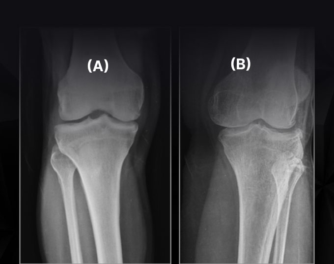Revolutionizing Osteoporosis Detection with AI and Cloud Computing: The CareVision Solutions Story